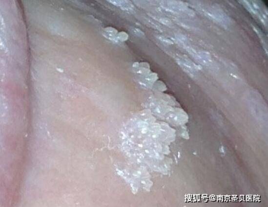 尖锐湿疣白醋实验会变白吗